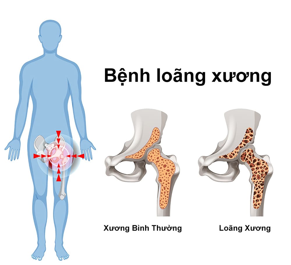 loang-xuong-nen-an-gi