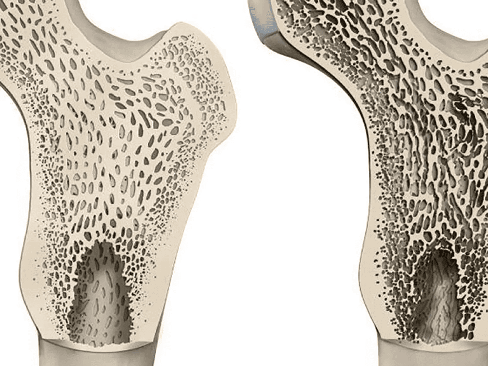 tac-hai-cua-benh-loang-xuong