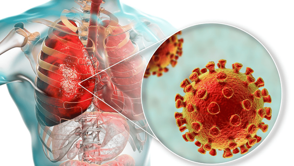 viem-phoi-nang-o-nguoi-lon