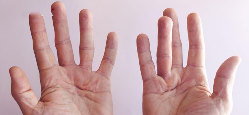 benh-co-rut-chan-tay-o-nguoi-gia