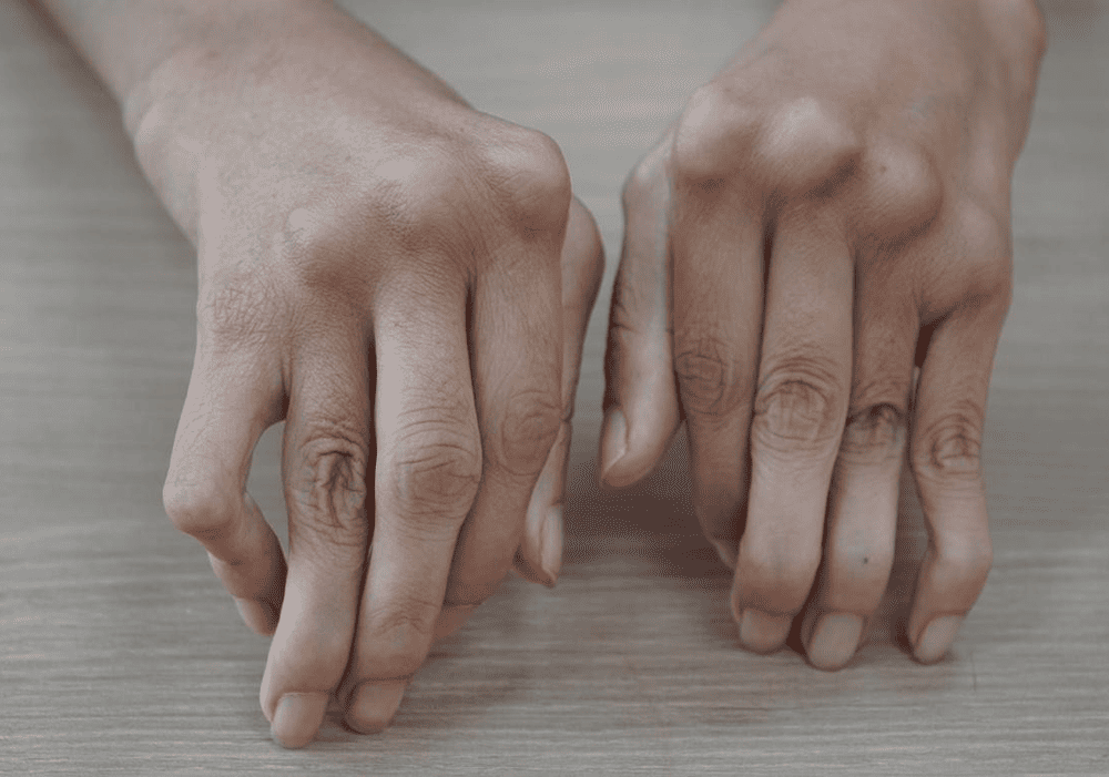 trieu-chung-viem-khop-dang-thap