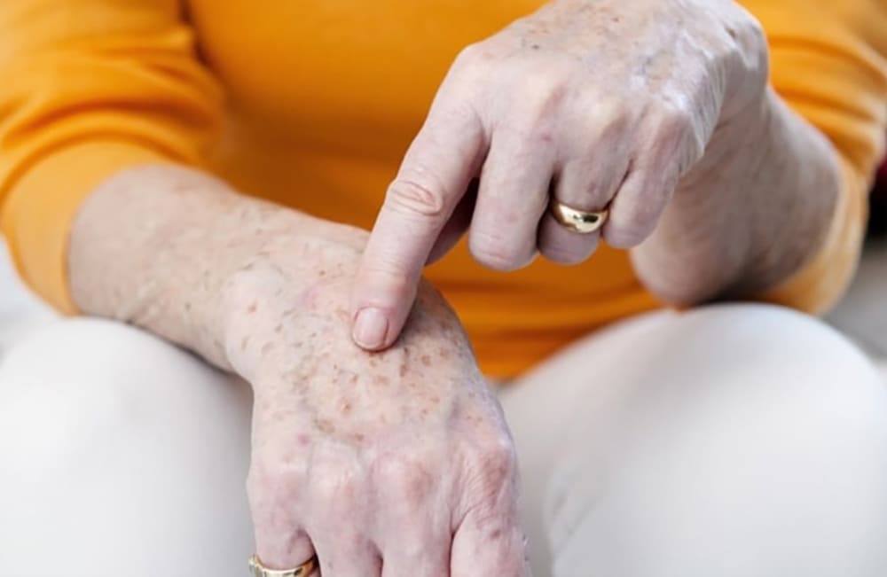 đồi mồi ở người già