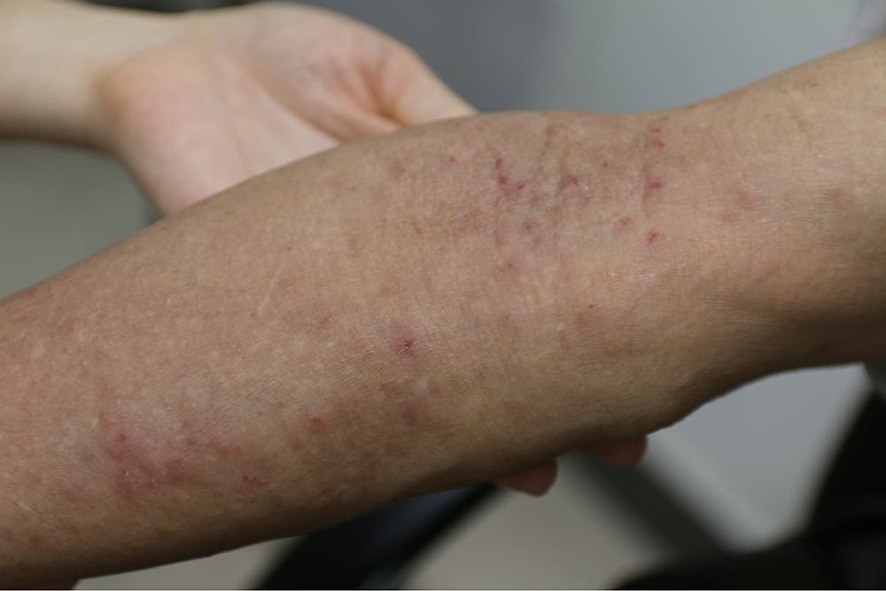 ngứa toàn thân ở người già