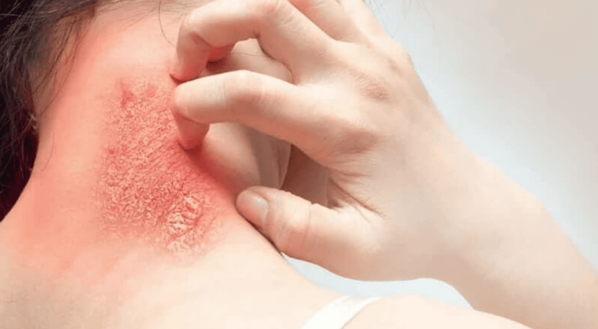 người già nằm lâu bị loét