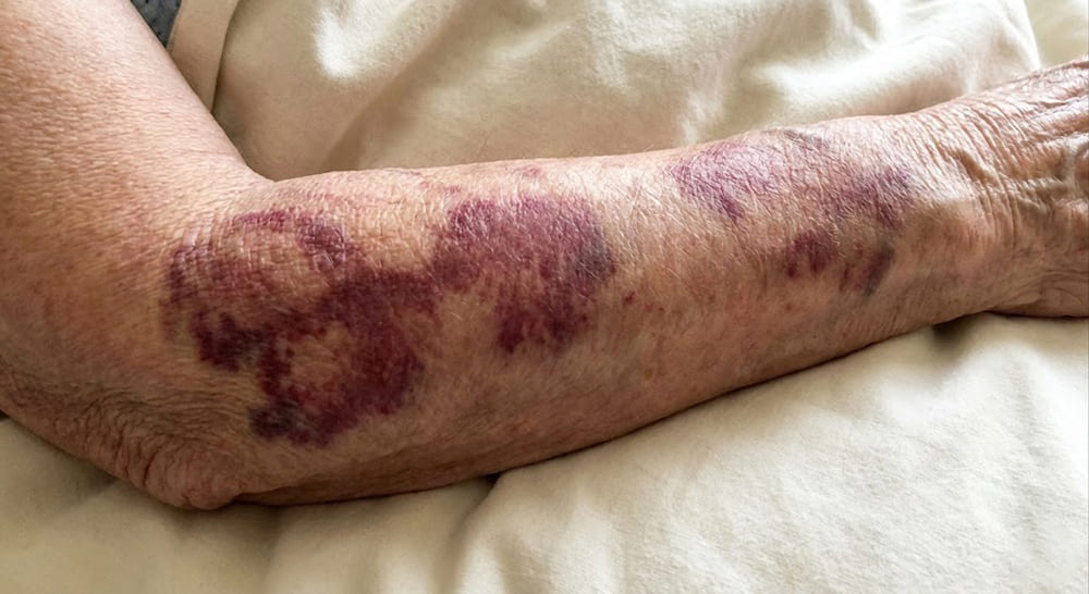 xuất huyết dưới da ở người già