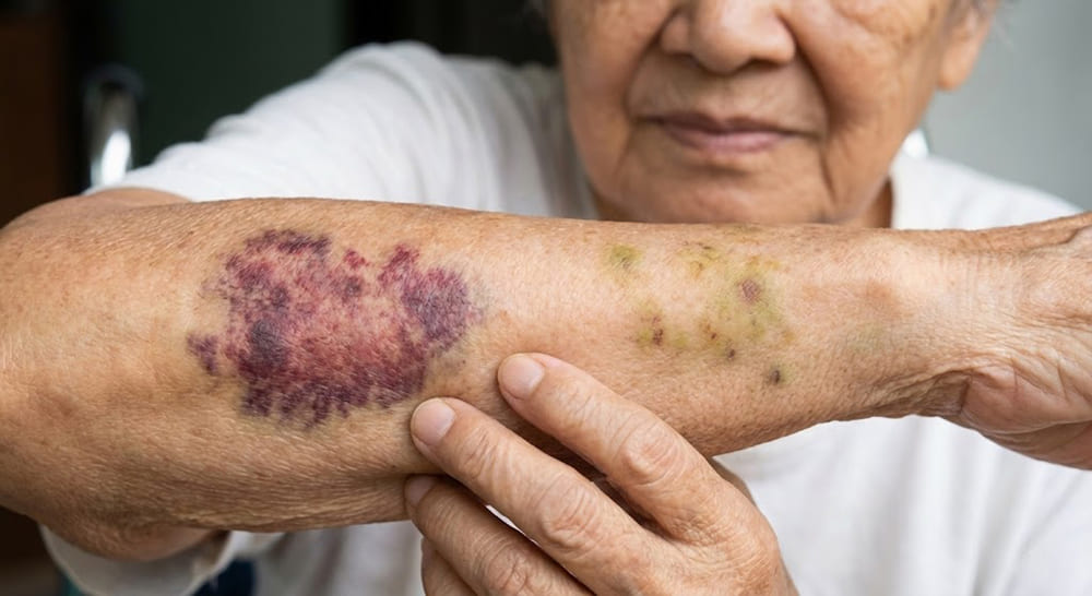 xuất huyết dưới da ở người già